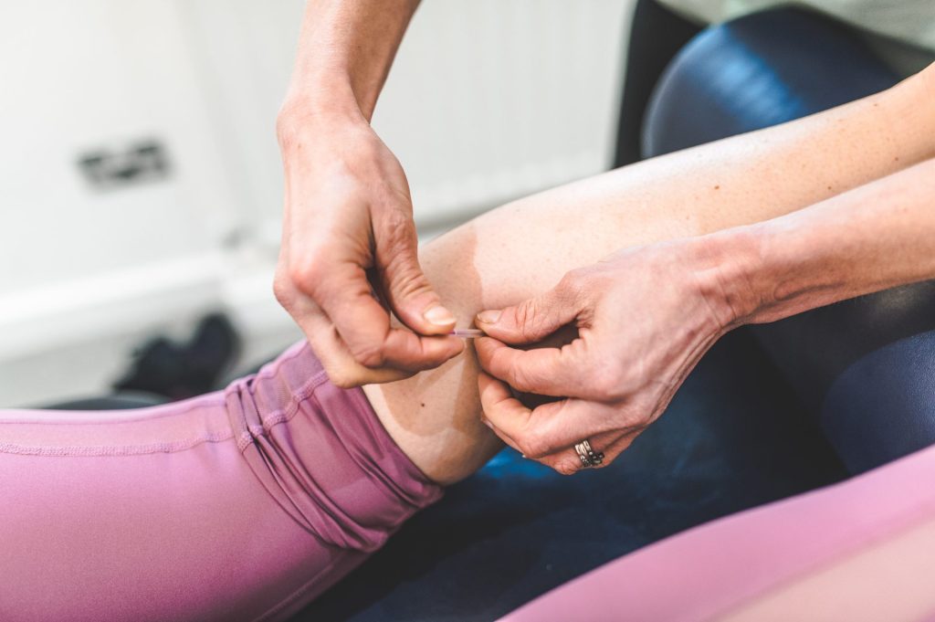 acupuncture in sheffield